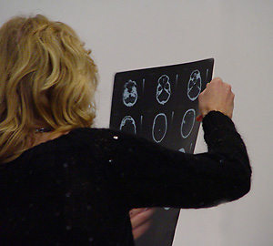 DAI-student taking a closer look at a CT-scan that clearly shows the specific area(s) damaged by a stroke.