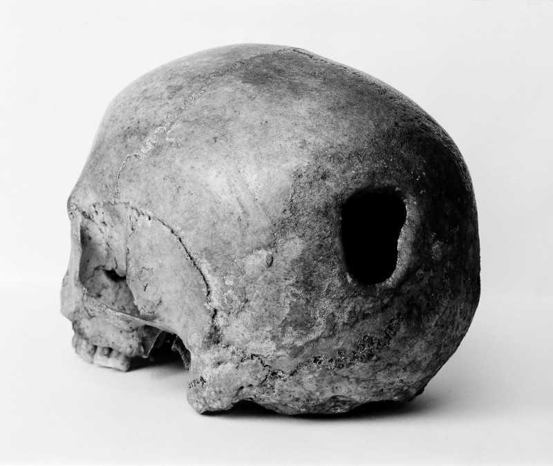 Edinburgh Skull. Trepanning hole in back of human skull, 7000 BCE.
